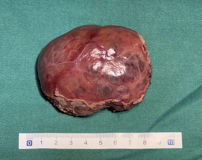 【動態(tài)】首兒所武玉睿團隊完成高水準ICG引導單孔+1腹腔鏡肝母細胞瘤精準切除手術(shù)(圖5)