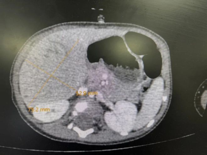 【動態(tài)】首兒所武玉睿團隊完成高水準ICG引導單孔+1腹腔鏡肝母細胞瘤精準切除手術(shù)(圖2)