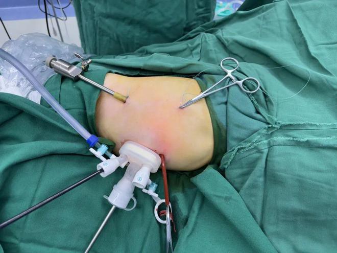 【動態(tài)】首兒所武玉睿團隊完成高水準ICG引導單孔+1腹腔鏡肝母細胞瘤精準切除手術(shù)(圖3)